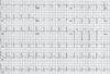 A Case of Heart vs Head:Cardiac Manifestations of Cerebrovascular Injury