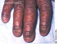 Nondermatophyte Onychomycosis