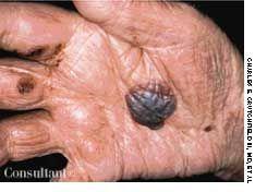 Bullous Pemphigoid (Hemorrhagic)