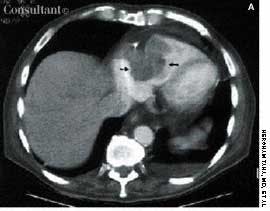 Primary Cardiac Lymphoma