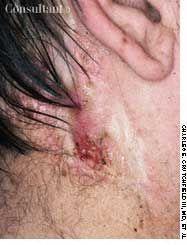 Atypical Fibroxanthoma