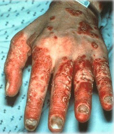 Erosive Dermatits, Arthritis, and Urethritis: Dx?