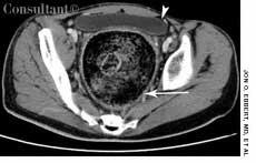 Traumatic Brain Injury and Fecal Retention