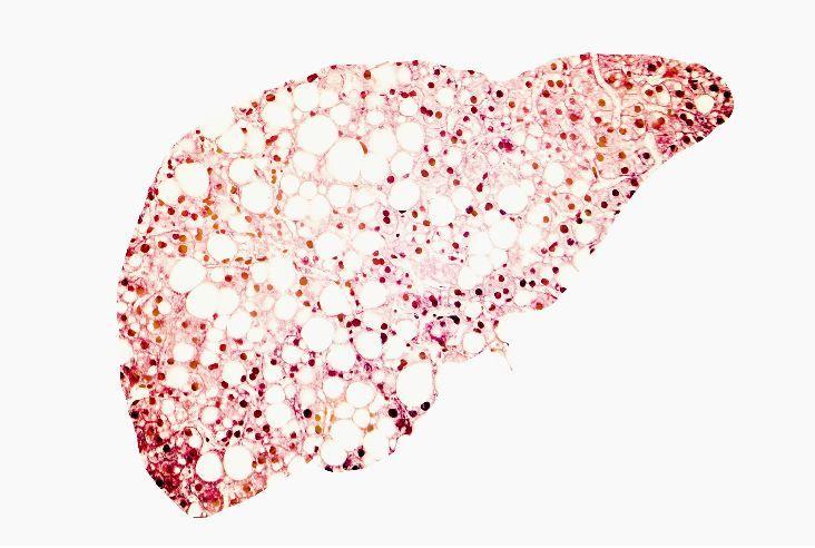 NAFLD and Weight Loss: Study Quantifies Dose-response Relationship