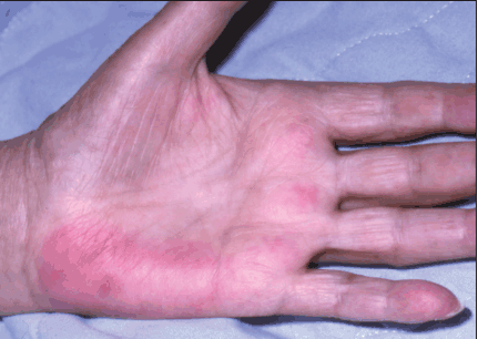 palmar erythema