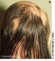 Alopecia Areata