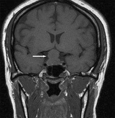 Lymphocytic Hypophysitis