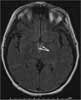 Wernicke Encephalopathy