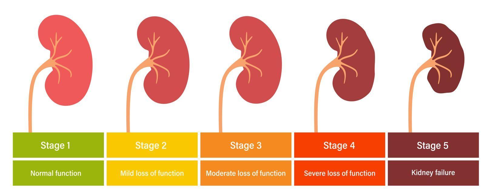 Rapid Progression of CKD Can Be Detected Early Using Simple Markers in Primary Care / Image credit kidney disease progression: ©pikovit/stock.adobe.com