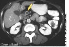 Superior Mesenteric Vein Thrombosis