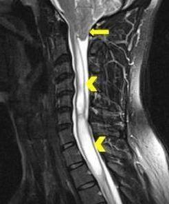 Constant Headache and Neck Pain