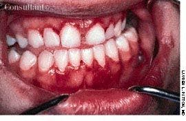 Linear Gingival Erythema