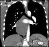 Hematemesis Secondary to a Bronchogenic Cyst