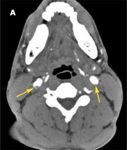 Carotid Dissection From Weight Lifting