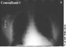 Achalasia in a 48-Year-Old Man