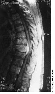 Spinal Cord Compression