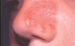 Scaly Plaque on the Nose