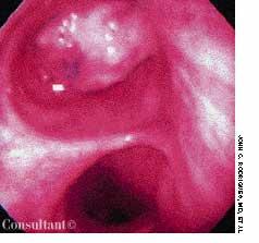 Endobronchial Metastatic Disease