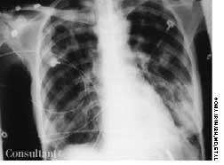 Pulmonary Tuberculosis