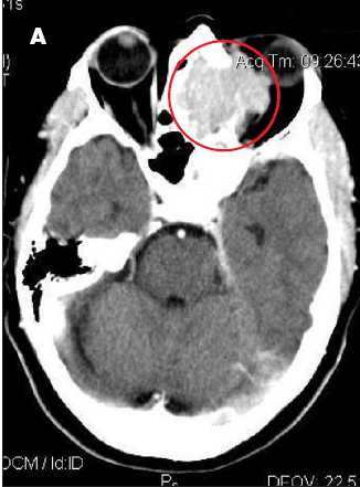 Large B-Cell Lymphoma