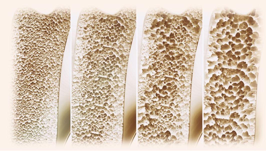 Biosimilars to Denosumab Win FDA Approval as Amgen and Sandoz Go to Court / image credit osteoporosis progression: ©crevis/stock.adobe.com