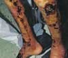 Cutaneous Mycobacterium Infection