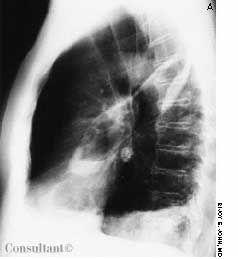 Abscess in Fissure