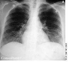 Pulmonary Arteriovenous Malformation