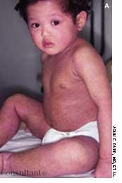 Atopic Dermatitis