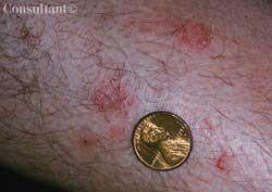 Nummular Eczema: Don't Mistake it for a Fungal Infection  