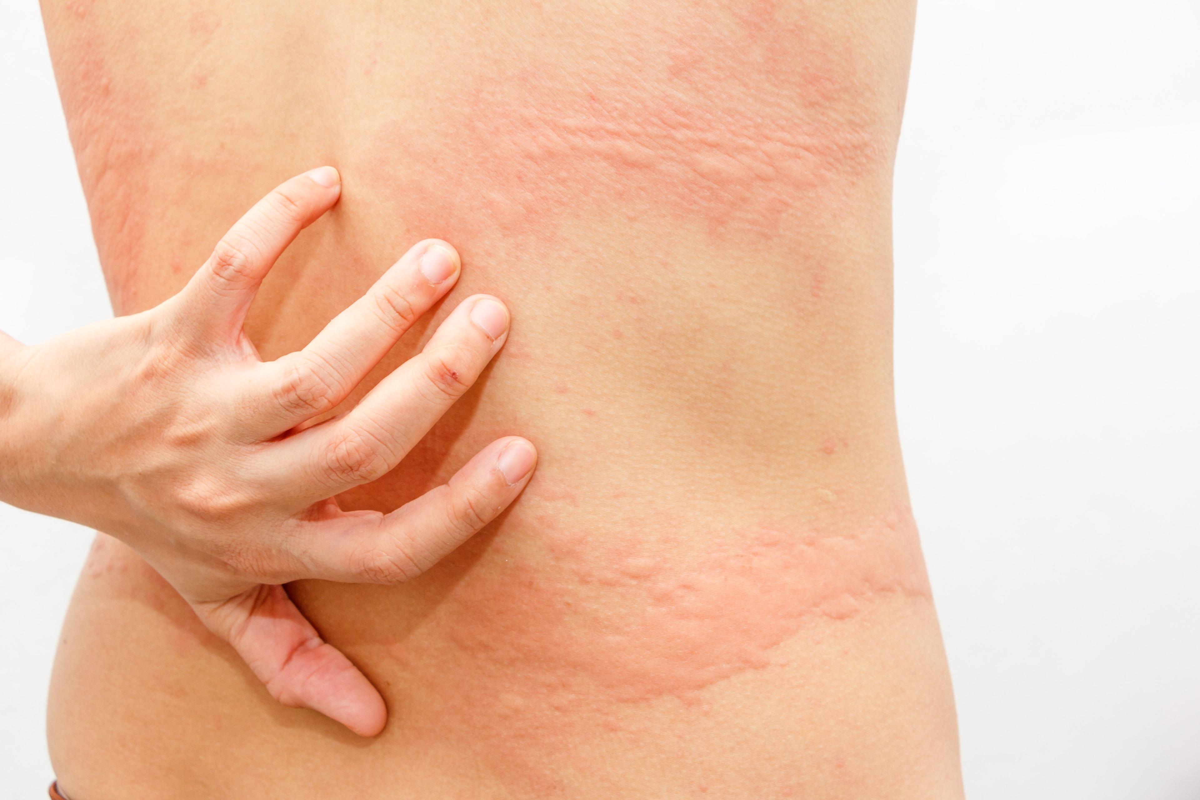 chronic hives, chronic Spontaneous Urticaria