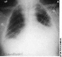 Myxedema Heart