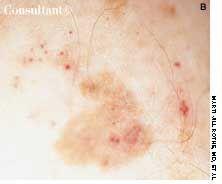 Pigmented Bowen's Disease