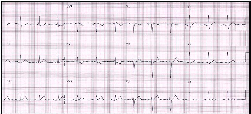 Subtle ST-Segment Elevation in Inferior Leads: Is This an Infarction?