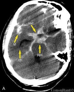 Subarachnoid Hemorrhage