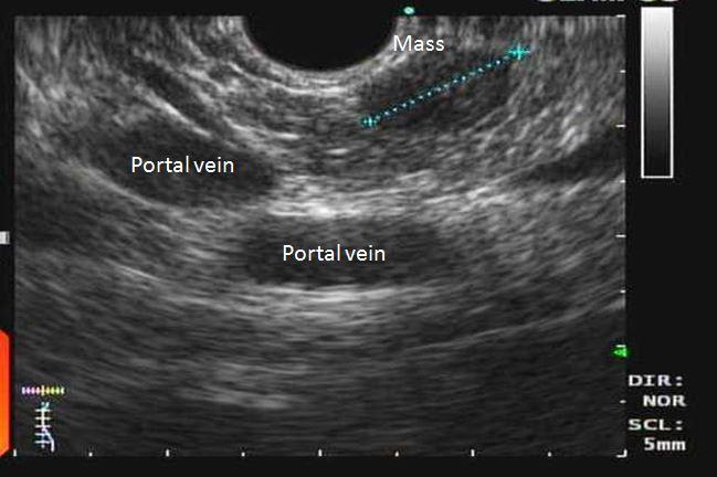 Blurred Vision and Palpitations in a Young Woman 