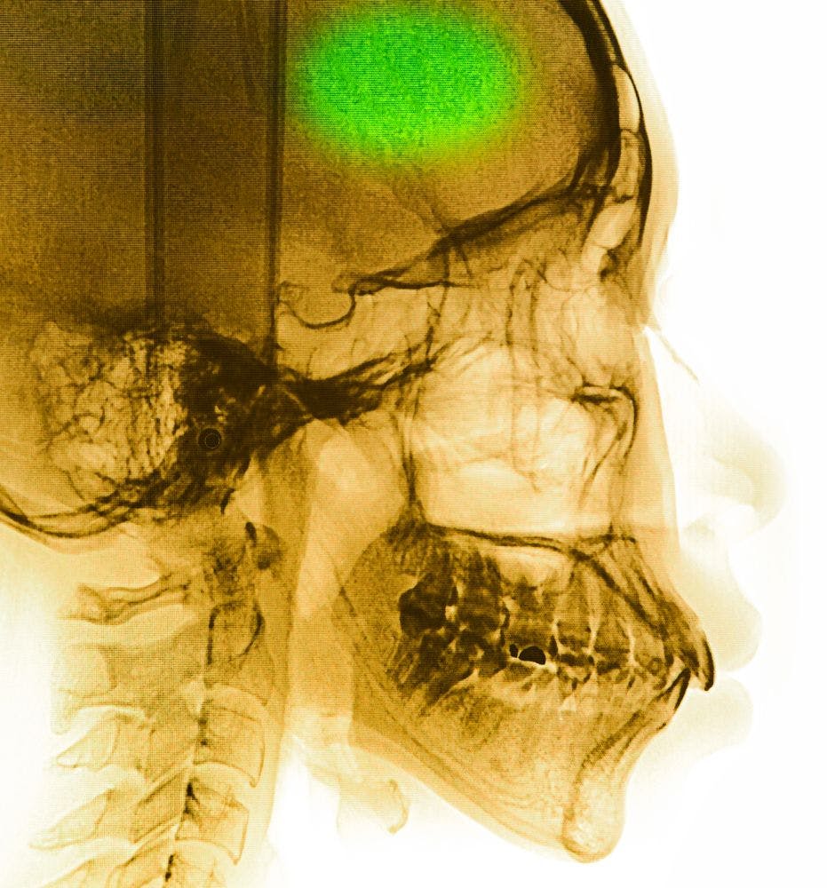 Ablation Therapy for AF: Who, What is it Good For? 