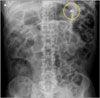 Foreign-Body Ingestion in a Man With Parkinson Disease Dementia