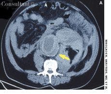 Ruptured Aortic Aneurysm