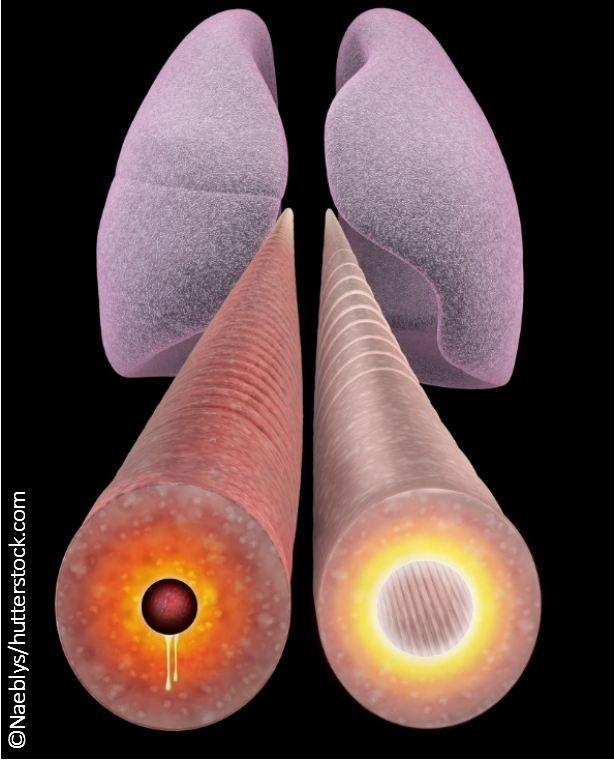 Mannitol Test for Asthma Presents Challenges