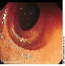 Celiac Disease