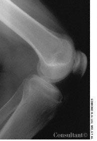 Osgood-Schlatter Disease