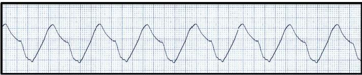 A Wide, Slow Cardiac Rhythm in a Lethargic Patient 