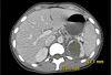 Renal Abscess Caused by Klebsiella Pneumoniae