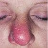 Nasal Cellulitis