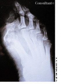 Tuberculous Arthritis