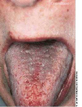 Black Hairy Tongue