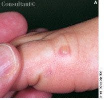 Hand-Foot-and-Mouth Disease