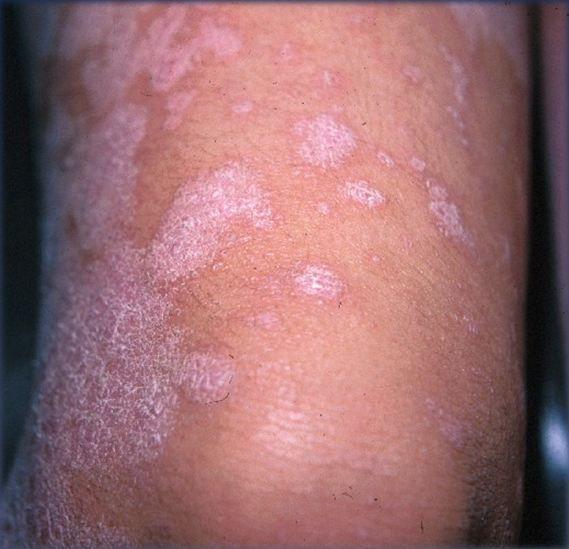 What Lichen Planus Looks Like: A Diagnostic Quiz