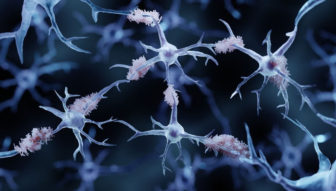 Lecanemab Efficacy Continues at 3 Years of Treatment for Early Alzheimer Disease / image credit amyloid plaques ©Artur/stock.adobe.com